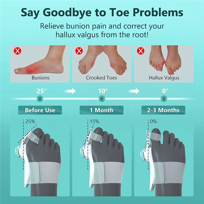 آتل اصلاح کننده انحراف انگشت پا TENICORE Bunion Corrector - 2